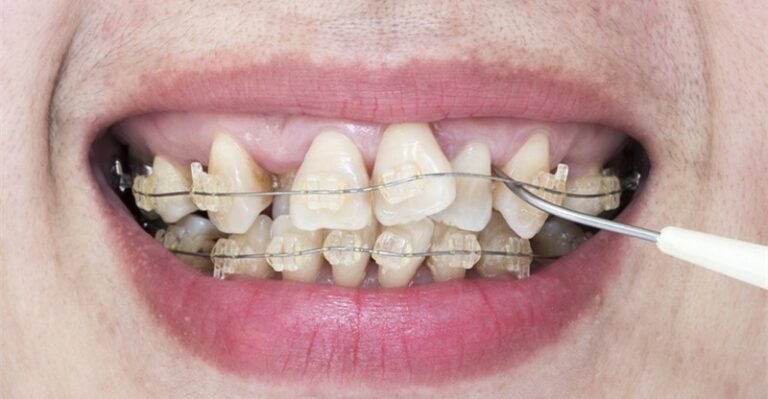 Wish to Get Rid of Crooked Enamel? Right here’s How